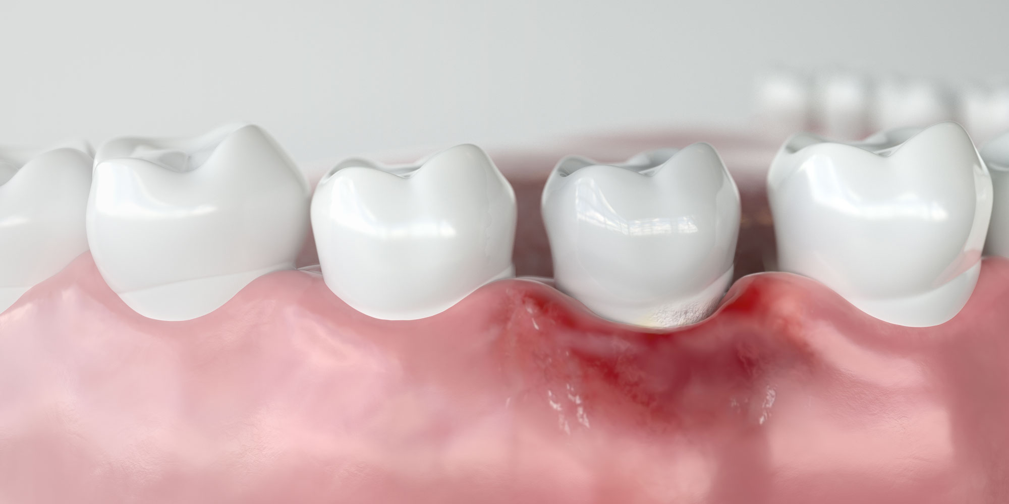 teeth model with gum disease Lafayette IN